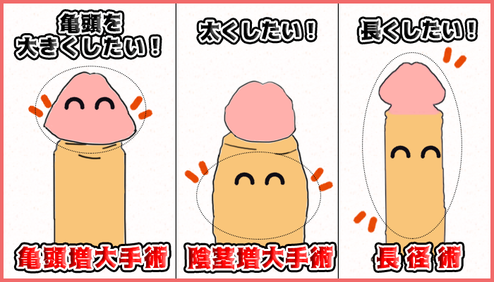 増大手術の種類別の大きくするポイントの図