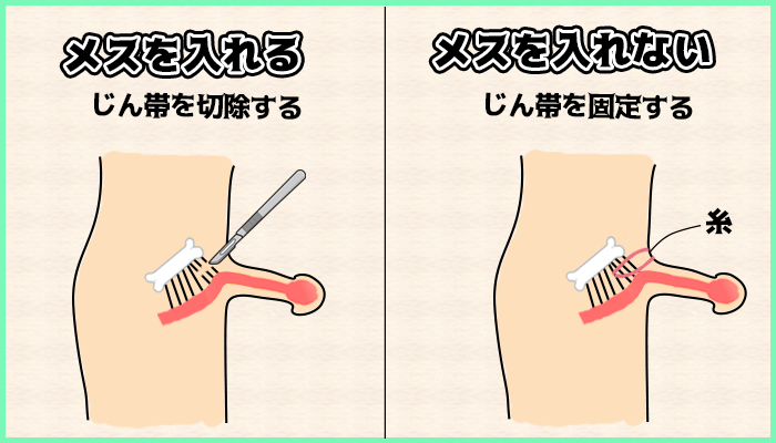 埋没陰茎修正術の図