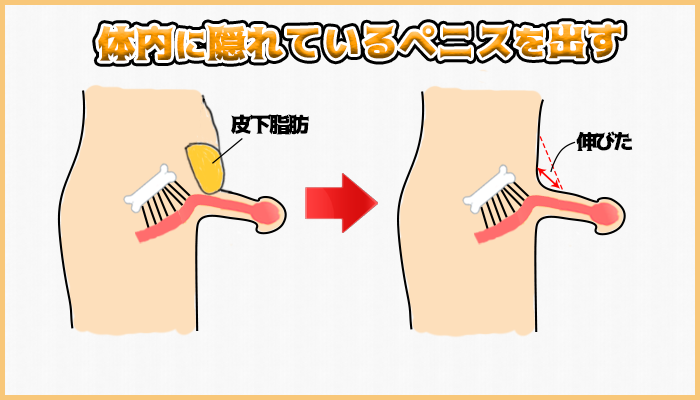 下腹部脂肪吸引式長茎術の図