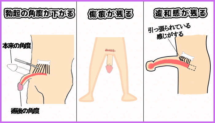 長茎術の3つの短所の図